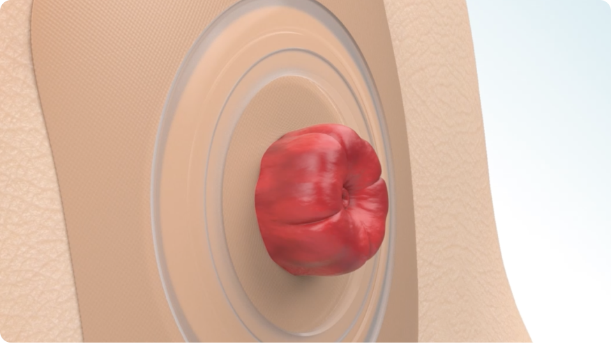 a drawing of a stoma