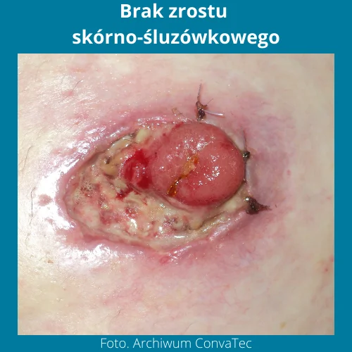 Stomia zdjęcia - brak zrostu skórno-śluzówkowego